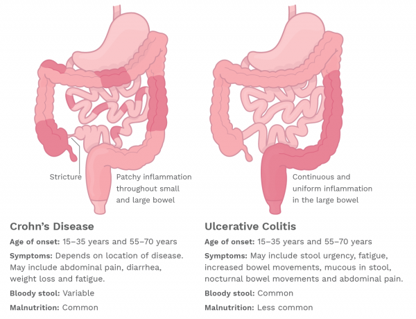 ulcerative colitis vs crohn's disease